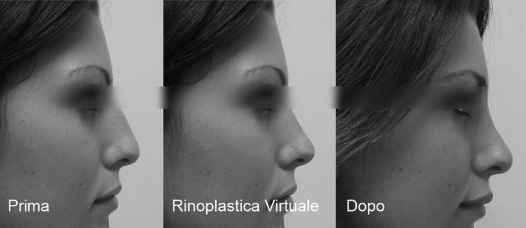 Rinoplastica virtuale