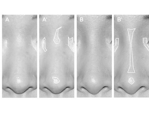 rinoplastica: studio dei riflessi sulla superficie del naso